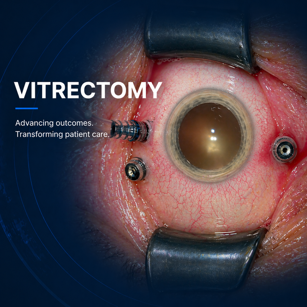 Vitrectomy